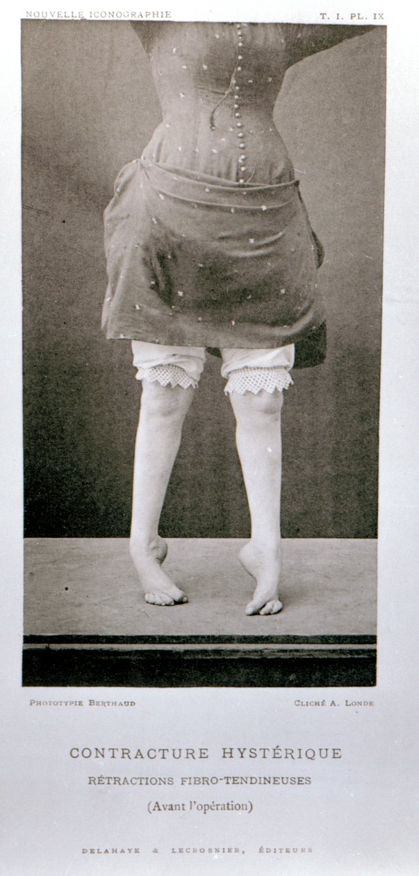 1889年にパリで出版されたジャンマルタンシャルコー教授（1825-93）による「ヌーヴェルイコノグラフィエデラサルペトリエール」の不随意拘縮 作： アルバート・ロンデ