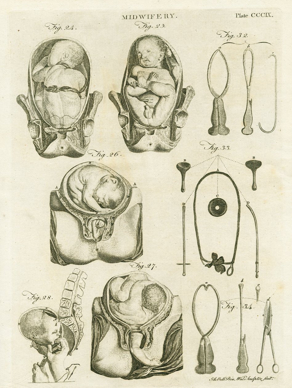 助産術、「百科事典ブリタニカ」のイラスト、エジンバラ、1798年に発行（銅版画） 作： アレクサンダー・ベル