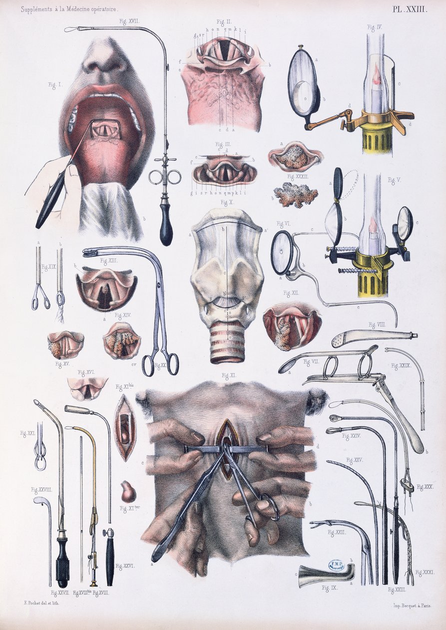 気管切開手術、ジャンバティストマルクブールジュリー（1797-1849）1866-67による「Traite Complet de l&39;Anatomie de l&39;Homme」のプレート 作： E.ポシェ