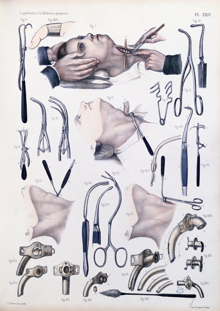 気管切開手術、ジャンバティストマルクブールジュリー（1797-1849）1866-67による「Traite Complet de l&39;Anatomie de l&39;Homme」のプレート 作： E.ポシェ