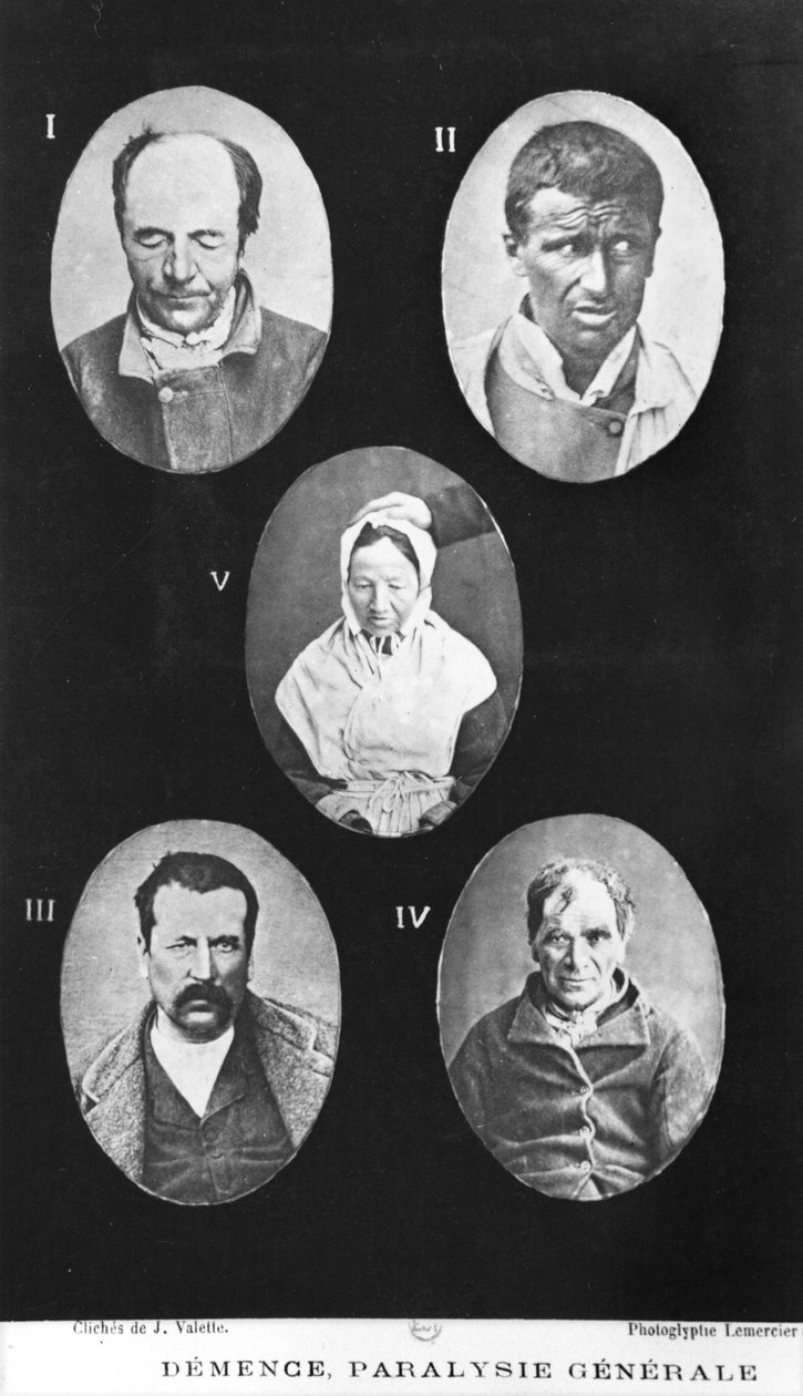 認知症、一般的な麻痺、ヘンリーダゴネット（1823-1902）、パリ、バイリエール、1876年による精神疾患の新しい基本的かつ実践的な治療からのイラスト 作： フランスの写真家