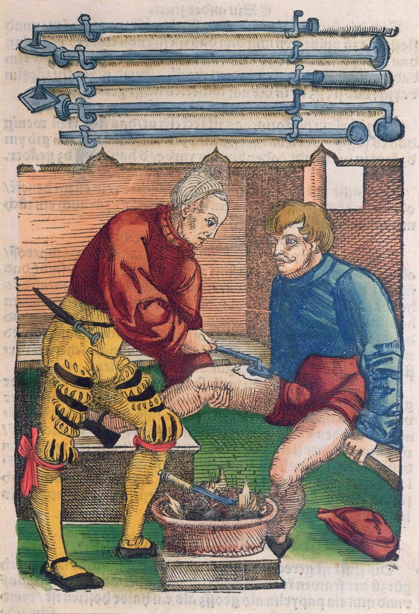 焼灼、ハンスフォンゲルスドルフの「フェルトブッフデアヴンダルツニー」のイラスト、c.1540（カラー木版画） 作： ハンスまたはヨハネス・ウルリッヒ・ウェヒトリン