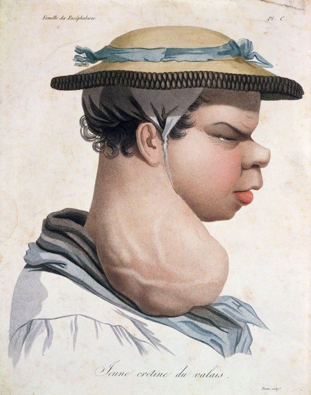 ヴァレー出身の若いクレティン、ジャン・ルイ・アリベール男爵（1768-1837）の本のイラスト 作： サルバドーレ トレスカ