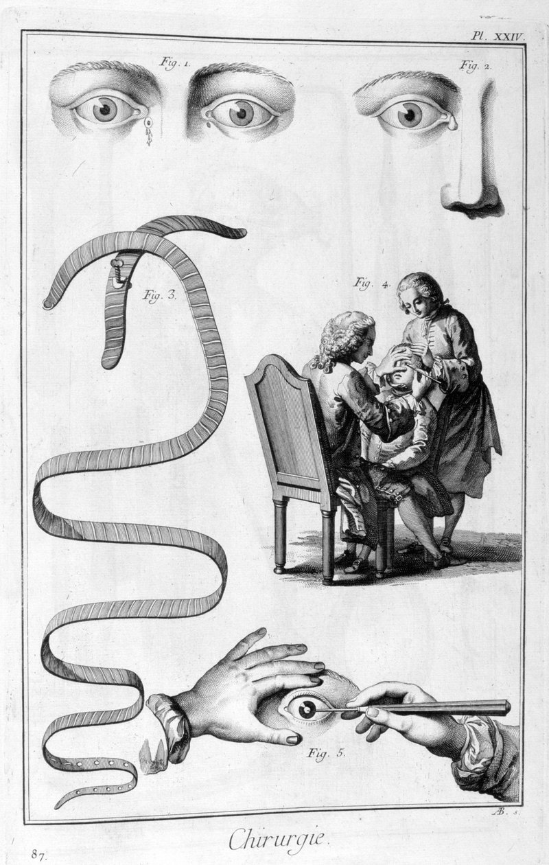 眼科手術、1751-1777 作： 不明