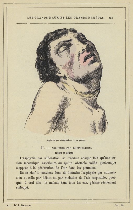 絞殺による窒息、絞殺された男性（カラーリトグラフ 作： フランス語学校
