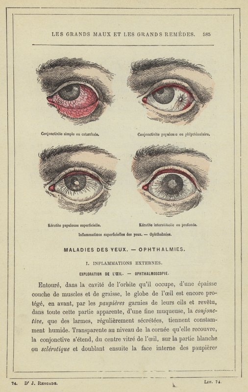 目の表面的な炎症、Ophthalmia（カラーリトグラフ 作： フランス語学校